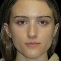 Case--23556 | Before Face