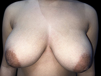 Case--22178 | Before Breast Reduction
