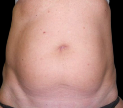 Case--20105 | Before Liposuction