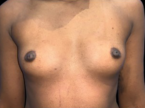 Case--21342 | Before Breast Augmentation