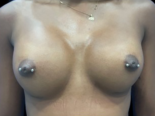 Case--21342 | After Breast Augmentation