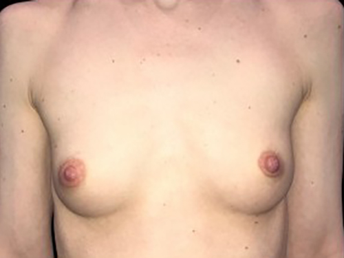 Case--21585 | Before Breast Augmentation