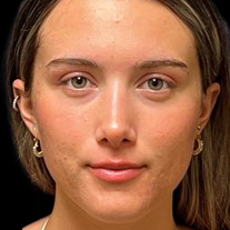 Case--23556 | After Face