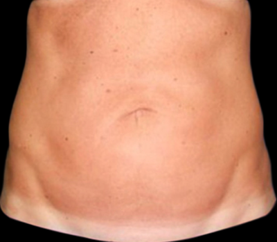 Case--20105 | After Liposuction