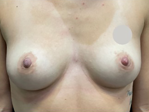 Case--21330 | Before Breast Augmentation