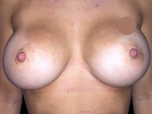 Case--21330 | After Breast Augmentation