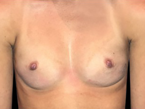 Case--21326 | Before Breast Augmentation