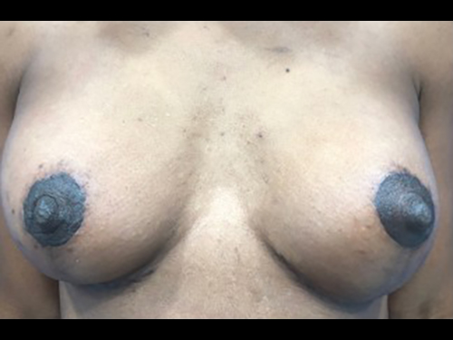 Case--21333 | After Breast Augmentation
