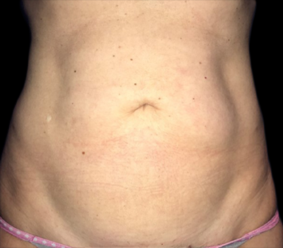 Case--20106 | Before Liposuction