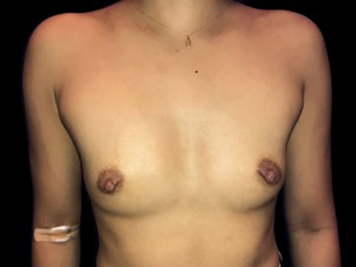 Case--21338 | Before Breast Augmentation
