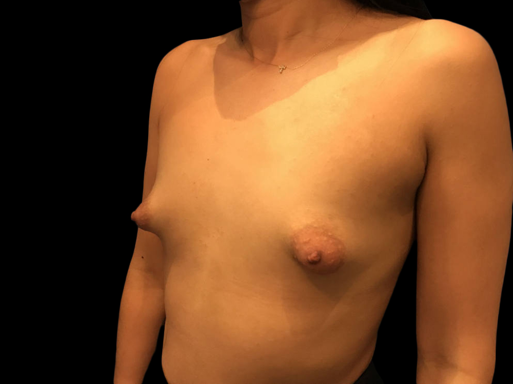 Case--21388 | Before Breast Augmentation