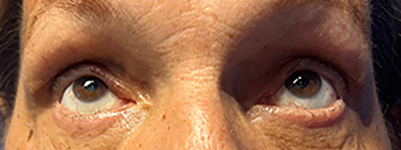 Case--21939 | After Face