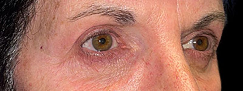 Case--21940 | After Face