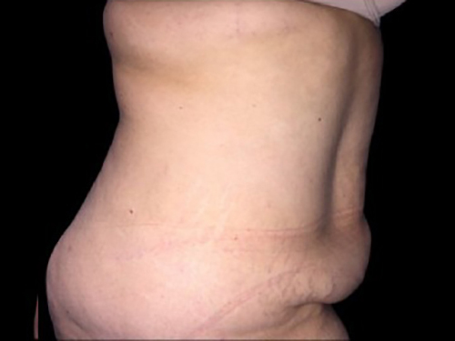 Case--21269 | Before Tummy Tuck