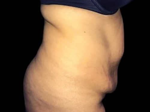 Case--21271 | Before Tummy Tuck