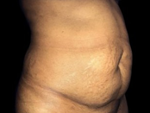 Case--21280 | Before Tummy Tuck