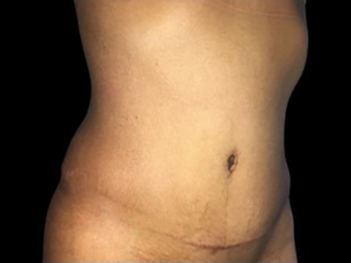Case--21280 | After Tummy Tuck