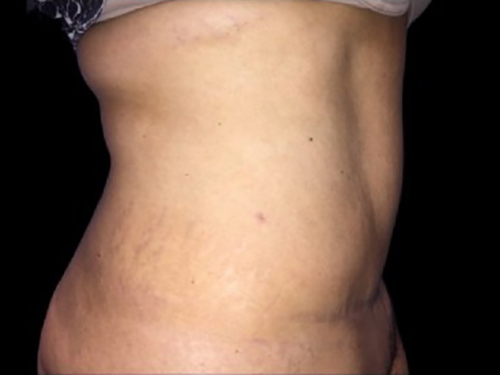 Case--21269 | After Tummy Tuck