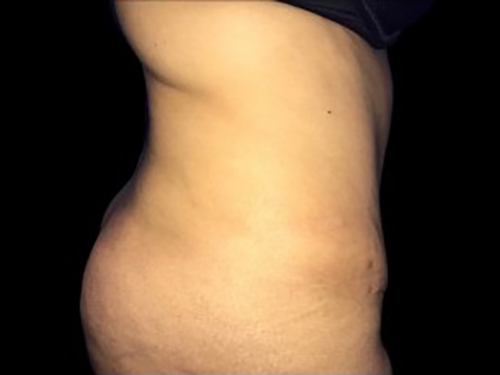 Case--21271 | After Tummy Tuck