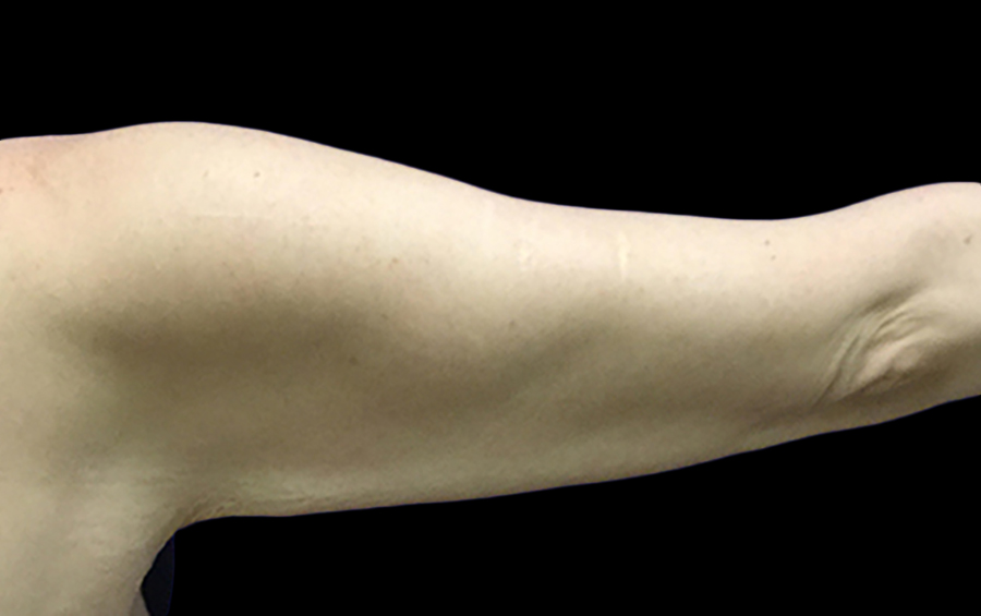 Case--21962 | Before Arm Lift