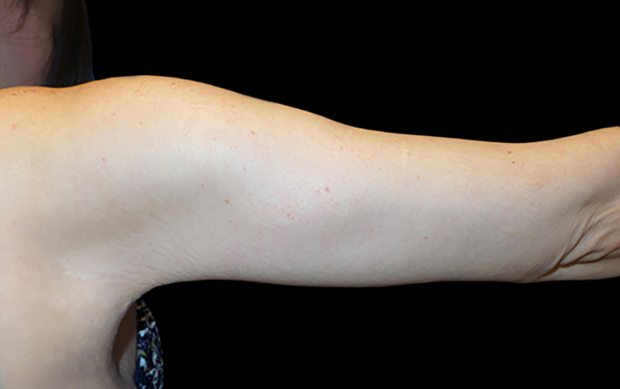 Case--21962 | After Arm Lift