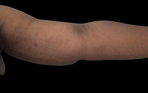 Case--21938 | After Arm Lift