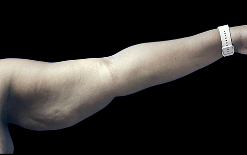 Case--21938 | Before Arm Lift