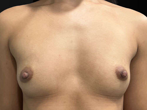 Case--6068 | Before Breast