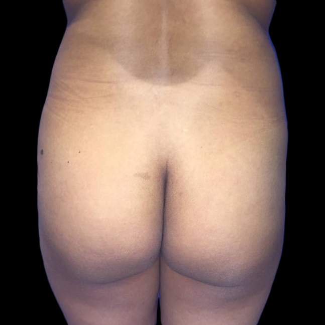 Case--19104 | Before Brazilian Butt Lift