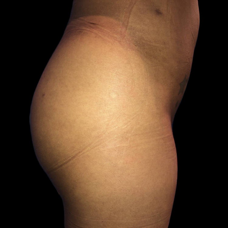 Case--19105 | After Brazilian Butt Lift