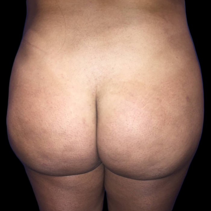 Case--19106 | After Brazilian Butt Lift