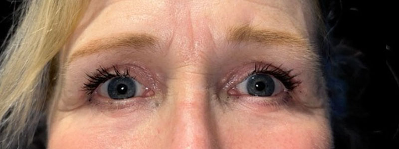 Case--9382 | After Blepharoplasty