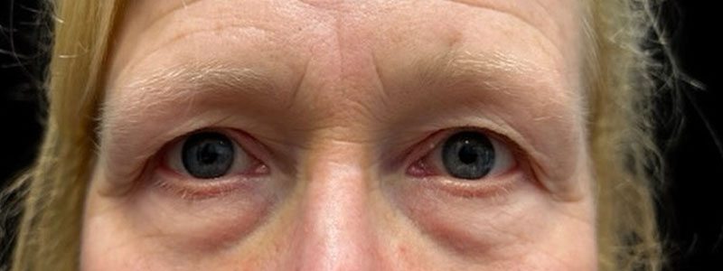 Case--9382 | Before Blepharoplasty