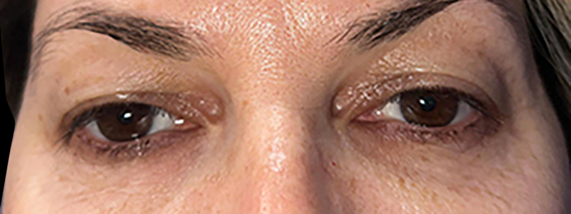 Case--21942 | Before Face