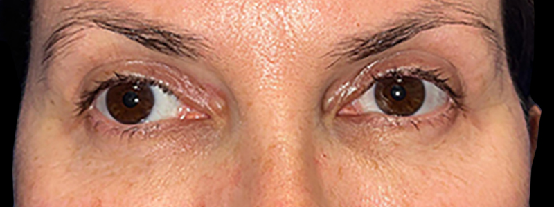 Case--21942 | After Face