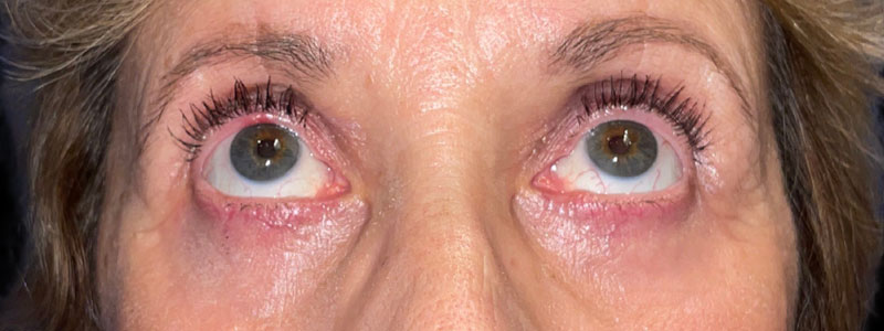 Case--4893 | After Face