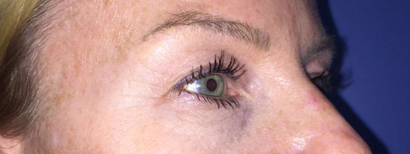 Case--6583 | After Face