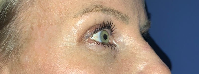 Case--6583 | Before Face