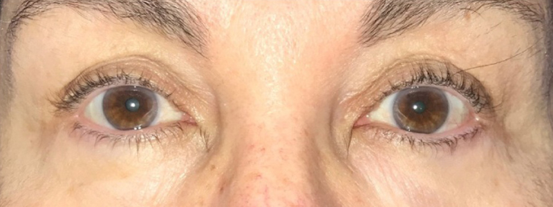 Case--20880 | After Face