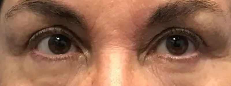 Case--20880 | Before Face