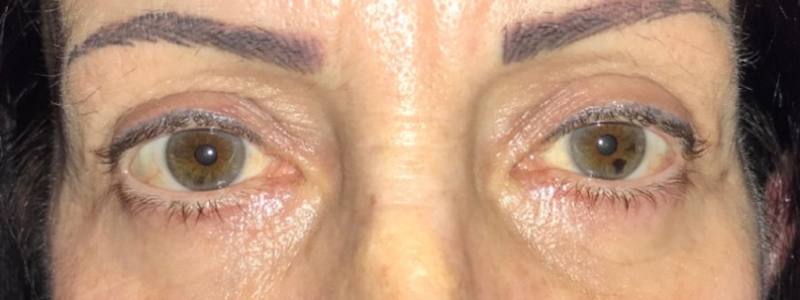 Case--20882 | After Face