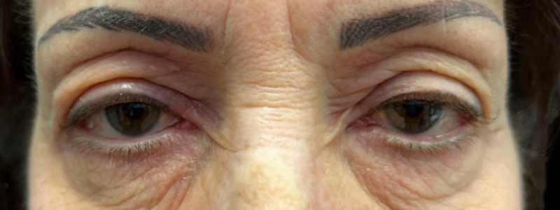 Case--20882 | Before Face