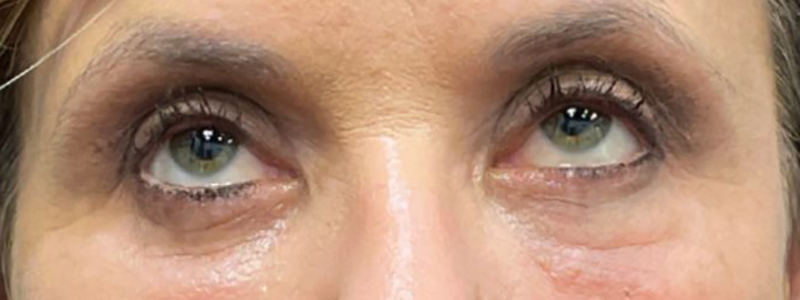 Case--20884 | After Face