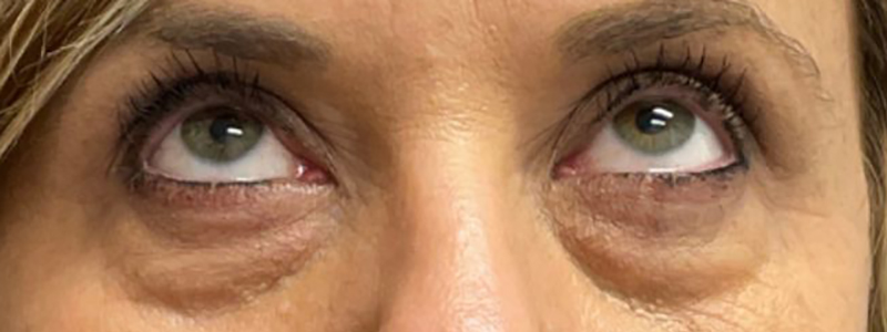 Case--20884 | Before Face