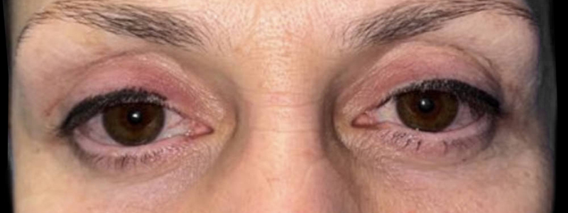 Case--20141 | After Face