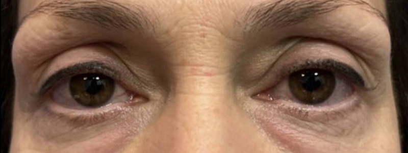 Case--20141 | Before Face