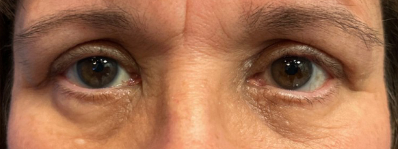 Case--20162 | After Face