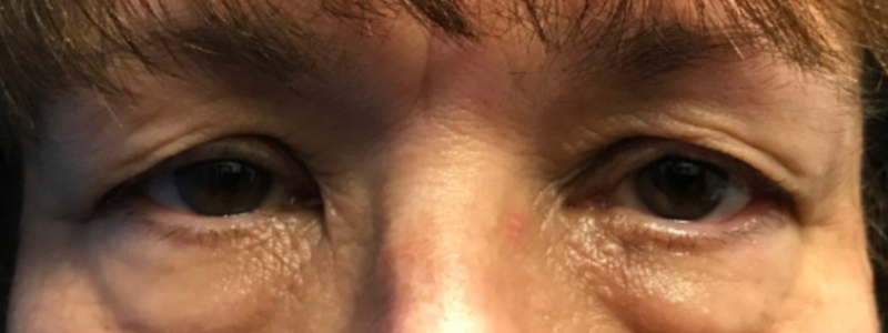 Case--20162 | Before Face