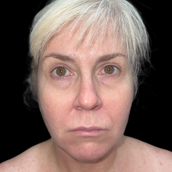 Case--19148 | Before Face