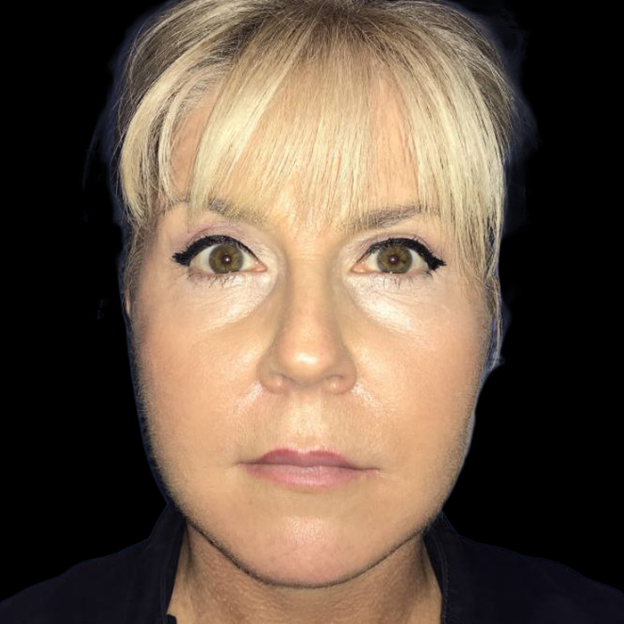 Case--19148 | After Face